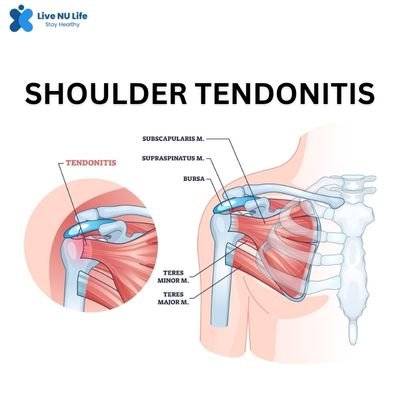 Shoulder Tendonitis Relief: Causes, Symptoms & Care