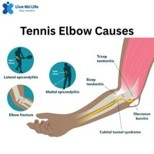 What is Tennis Elbow | tennis elbow causes
