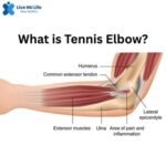 What is Tennis Elbow?