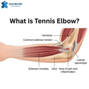 What is Tennis Elbow?