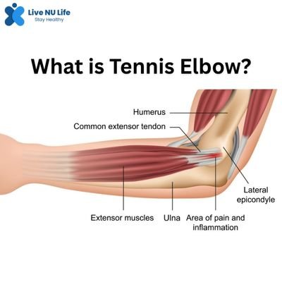 What is Tennis Elbow?