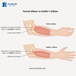 Overview of tennis elbow treatment Options