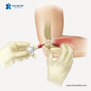 Orthopedic surgeon discussing tennis elbow surgery with patient